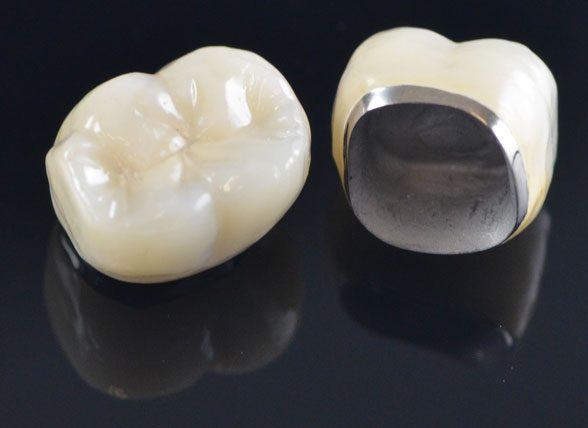 Возможность протезирования зубов с помощью металлической керамики