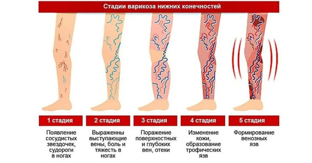 Виды осложнения варикозной болезни