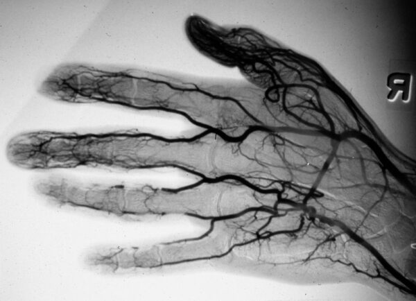 Компьютерная томография и ангиография сосудов